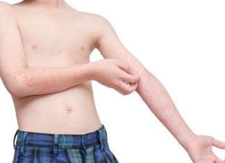 Rujeola – cauze, simptome, tratament