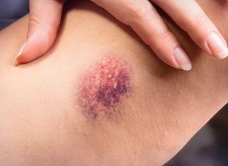10 remedii casnice impotriva vanatailor