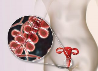 Secretii vaginale galbene cu si fara miros: 5 cauze si tratament