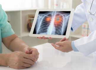 De ce este cancerul pulmonar principala cauza de deces in lume?
